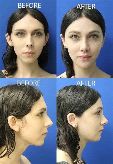 MTF Surgery Guide